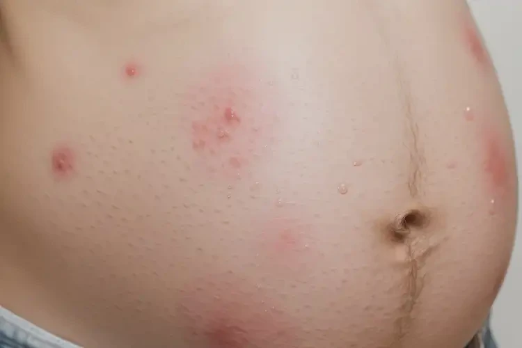 孕婦肚子起濕疹可以治好嗎(圖4)
