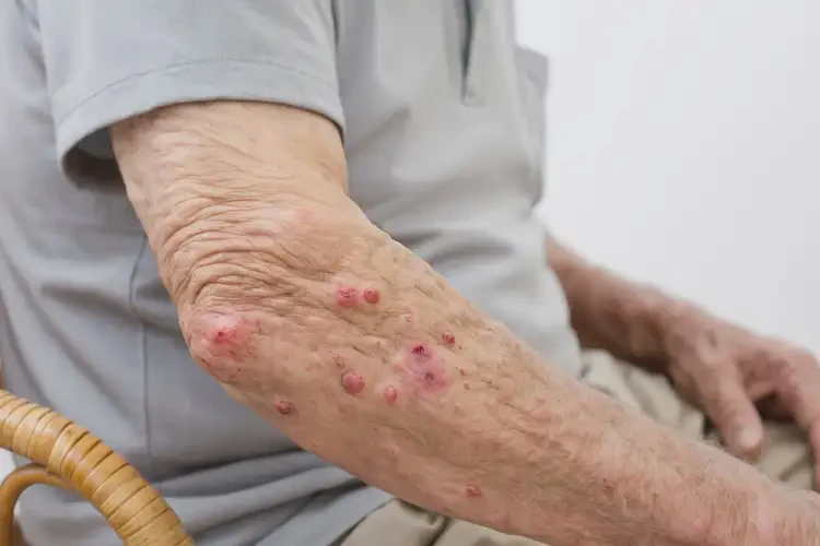 高龄老人手臂偶尔起湿疹可不可以根治(图4)