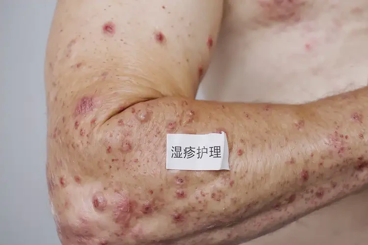 男人手臂起濕疹可不可以根治(圖4)