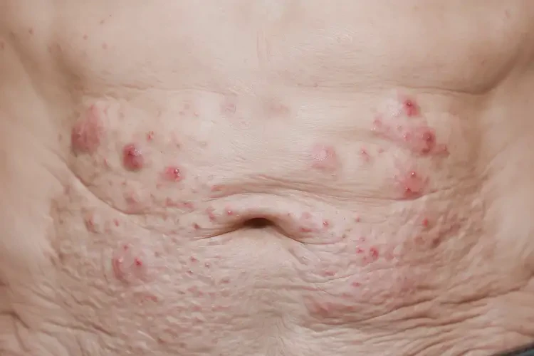 高齡老人肚子上長濕疹可不可以根治(圖4)