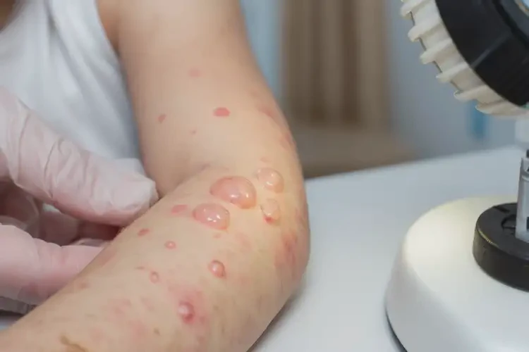 少兒手臂經(jīng)常長(zhǎng)濕疹可不可以徹底自愈(圖4)