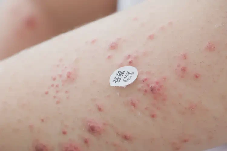 兒童身上起濕疹可以治好嗎(圖4)