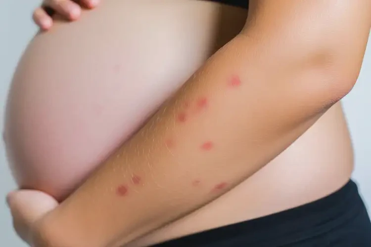 孕婦手臂上偶爾起濕疹可以治好嗎(圖1)