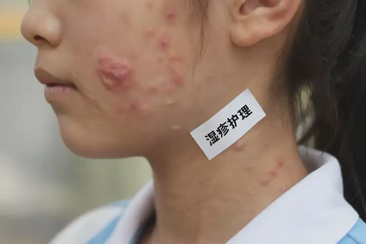 中學(xué)生脖子上長濕疹可以治好嗎(圖4)
