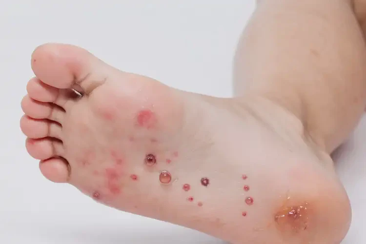 小兒腳上有濕疹可不可以根治(圖4)