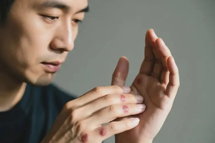 男人手上偶爾起濕疹可不可以根治(圖2)
