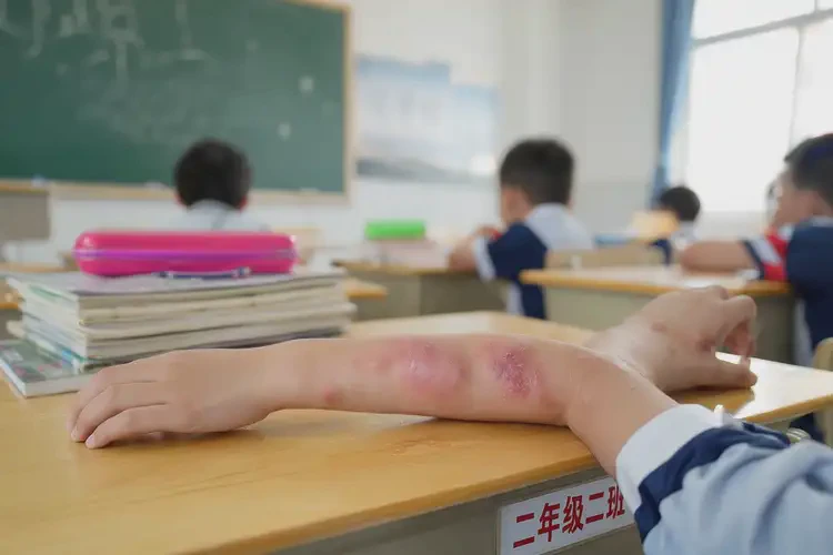 小學生屁股偶爾起濕疹可不可以根治(圖3)