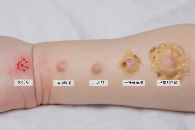 嬰兒手臂容易長濕疹可以治好嗎(圖1)