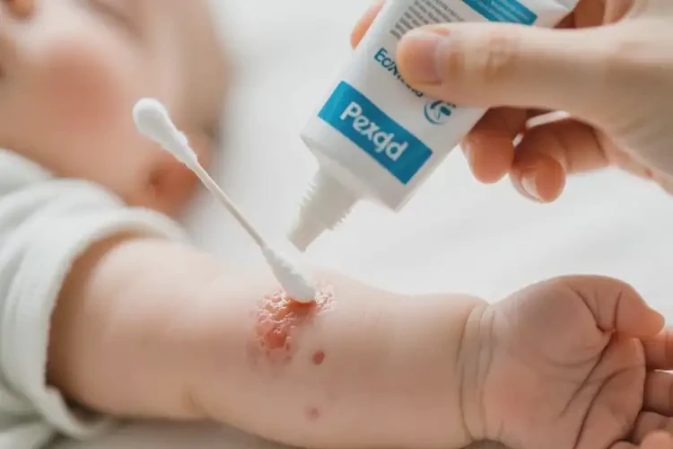 嬰兒手臂容易起濕疹可以治好嗎(圖1)