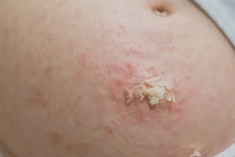 孕婦大腿上經(jīng)常長濕疹可以治好嗎(圖4)