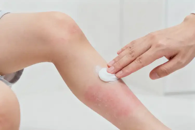 小孩小腿上經(jīng)常長濕疹可以治好嗎(圖4)