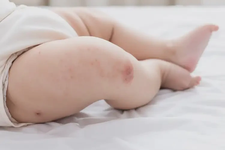 寶寶大腿上出濕疹可不可以徹底自愈(圖4)