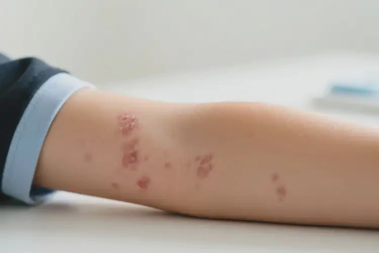 中學(xué)生手臂上偶爾長濕疹可不可以根治(圖4)