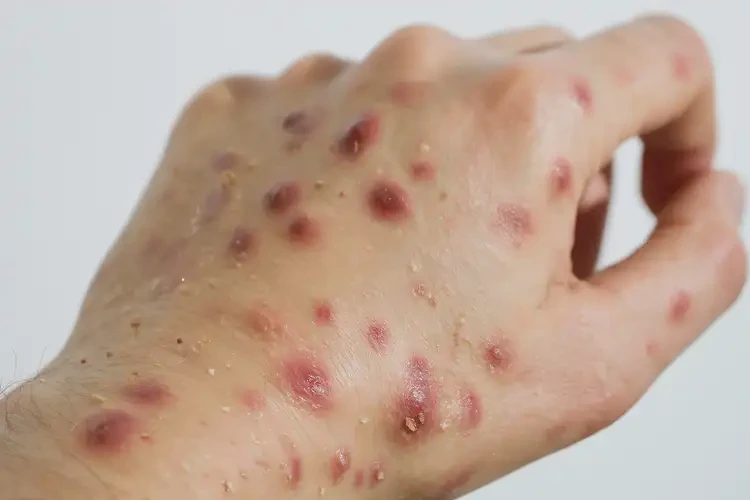 女人手上出濕疹可不可以根治(圖4)