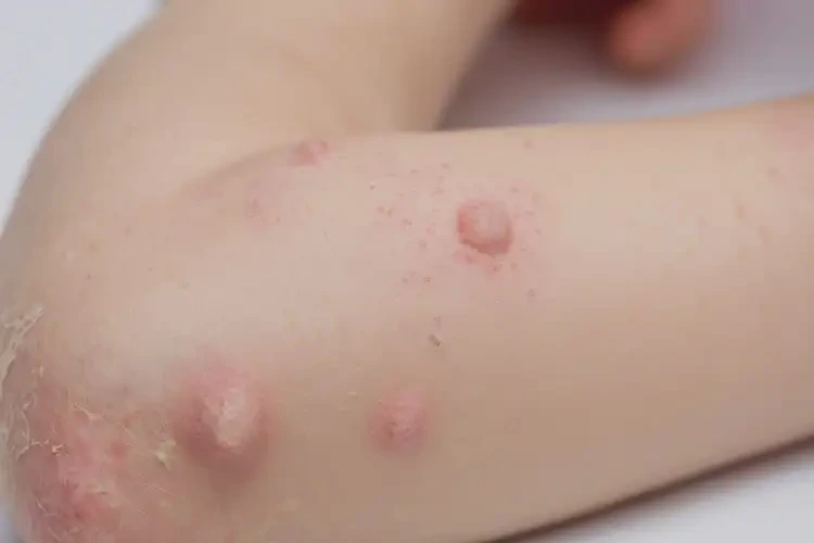 孩子手臂出現(xiàn)濕疹可不可以徹底自愈(圖4)