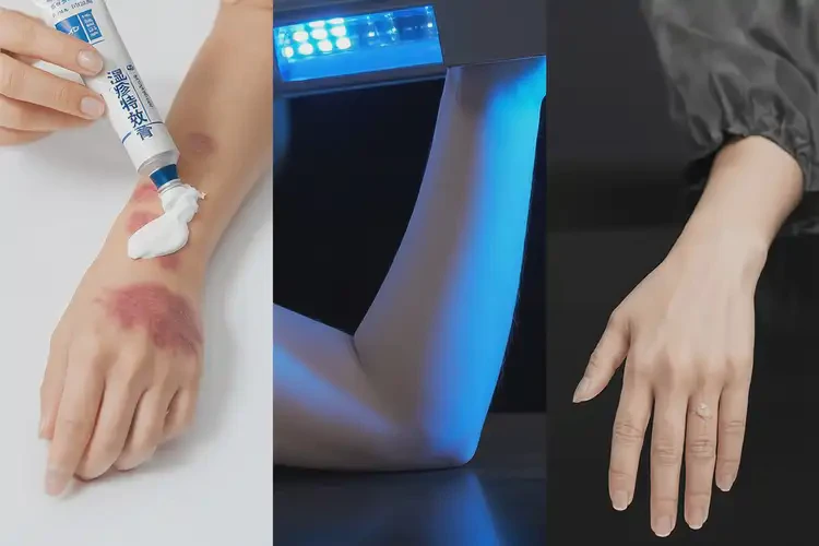 女性四肢容易長(zhǎng)濕疹可以治好嗎(圖2)