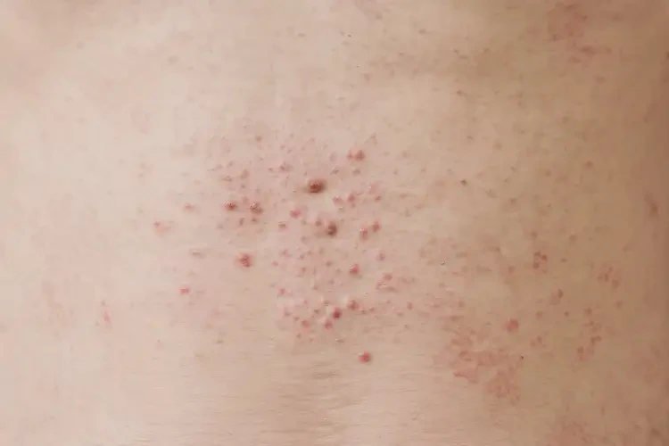 男生屁股容易起濕疹可以治好嗎(圖4)