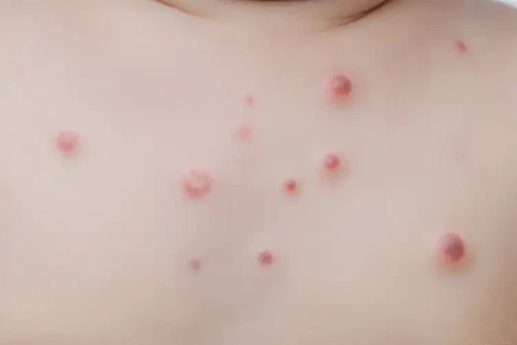 嬰兒脖子上起濕疹可以治好嗎(圖4)