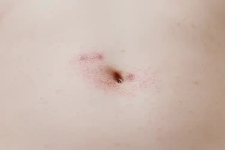 嬰幼兒肚子容易長(zhǎng)濕疹可以治好嗎(圖4)