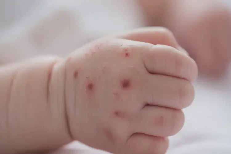 新生兒手上有濕疹可不可以根治(圖4)