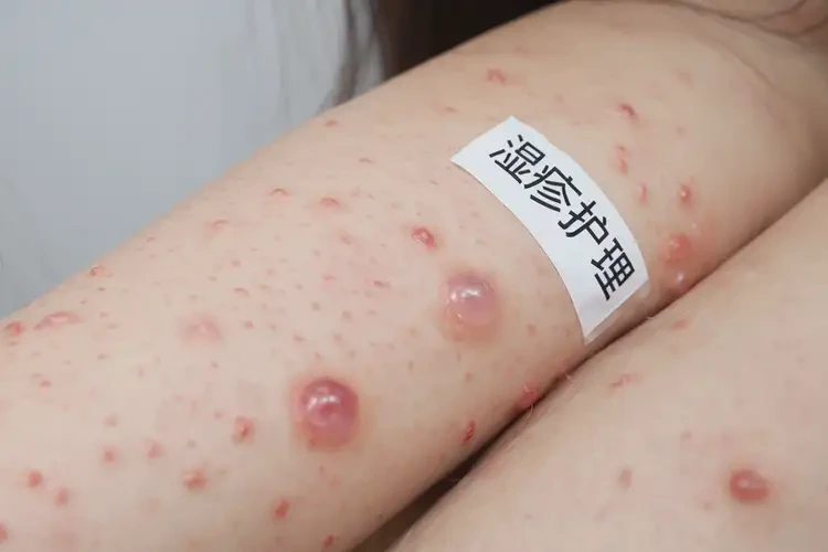 男人手臂上長(zhǎng)濕疹可不可以根治(圖4)