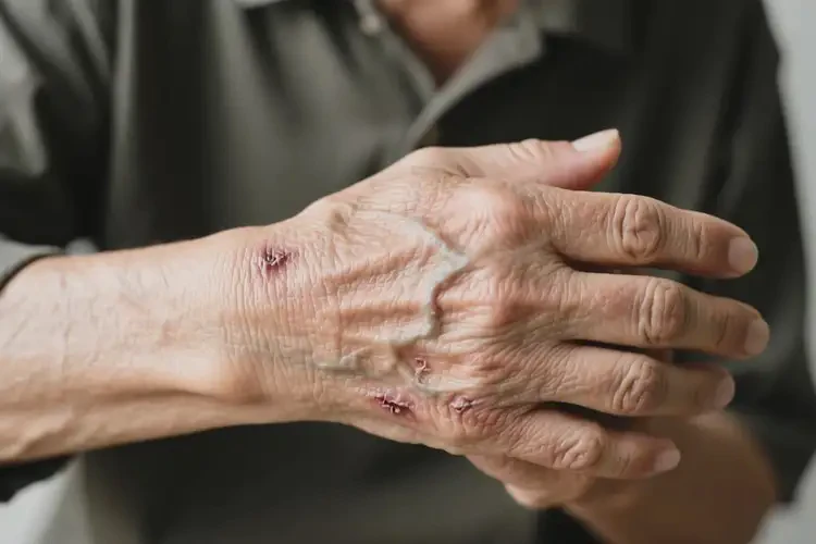 高齡老人手臂上有濕疹可不可以根治(圖2)