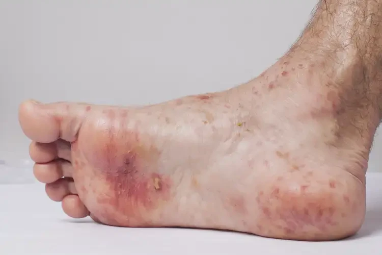 男性腳上起濕疹不管它會自己自愈嗎(圖4)