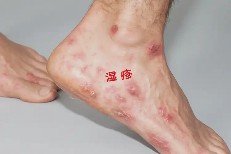 青年人腳上偶爾起濕疹可不可以根治(圖4)