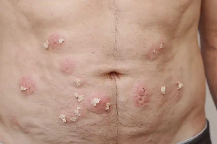 男人肚子上起濕疹可不可以根治(圖4)