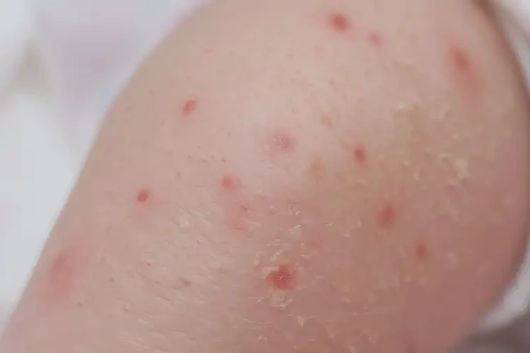 新生儿小腿上容易起湿疹能靠自己自愈吗(图4)