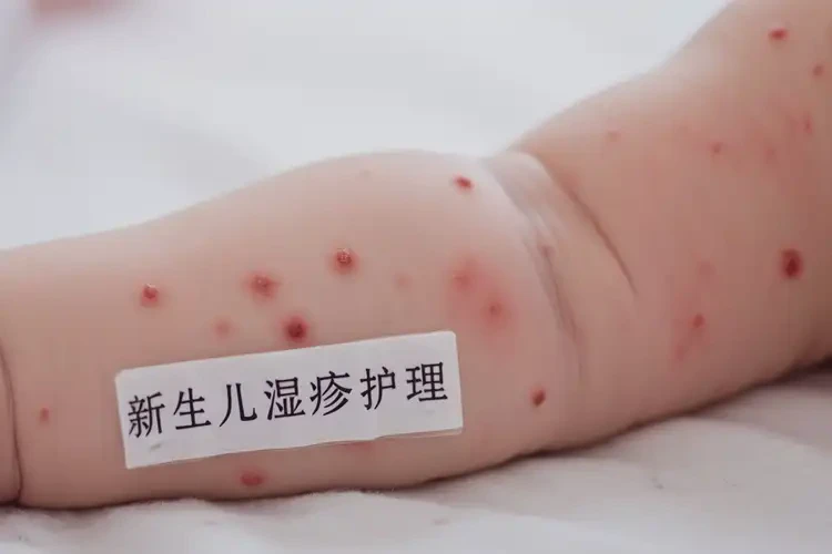 新生兒手臂上偶爾長(zhǎng)濕疹可不可以根治(圖4)