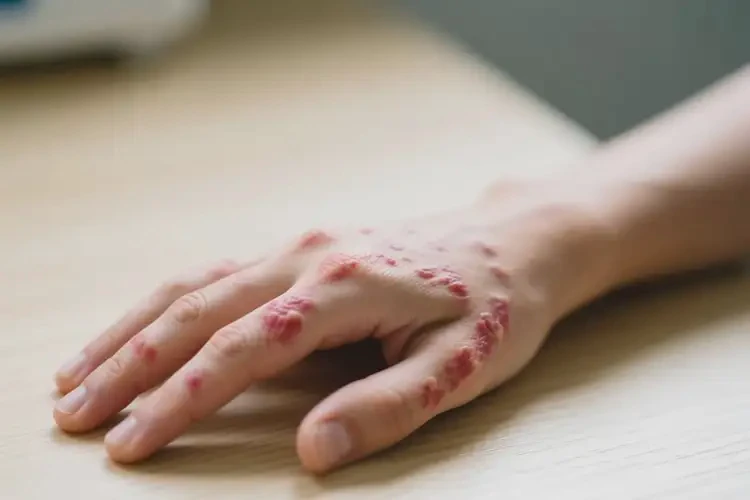 青少年手上長(zhǎng)濕疹可以治好嗎(圖4)