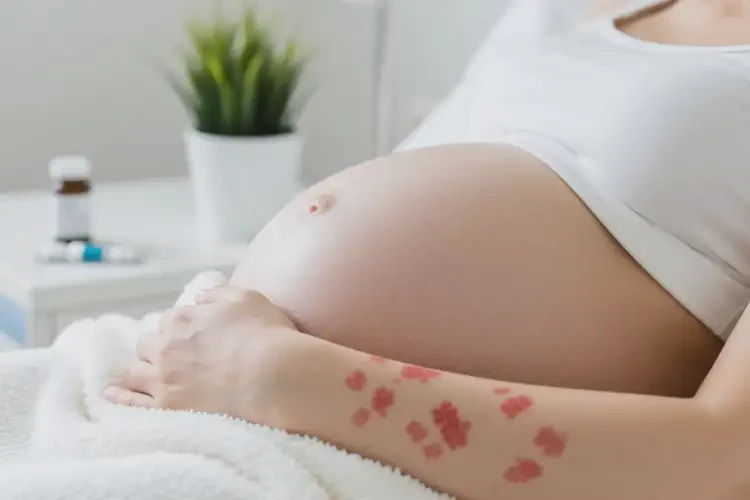 產(chǎn)婦手臂上偶爾起濕疹可以治好嗎(圖3)