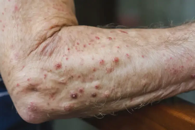 老年人全身偶尔起湿疹能够彻底治愈吗(图4)