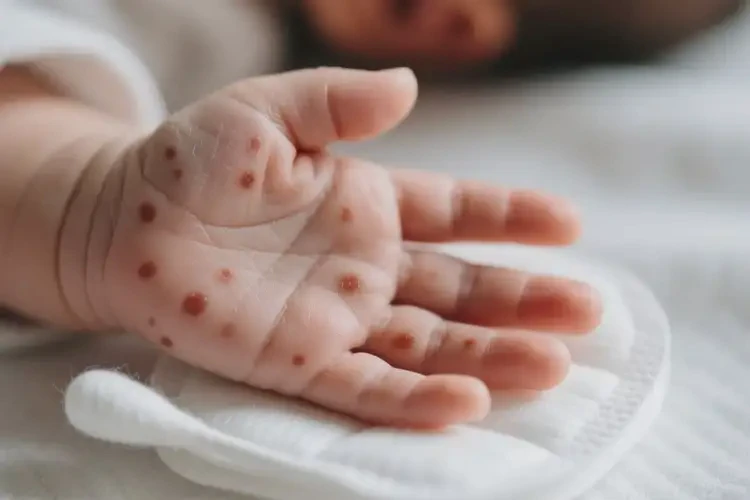 新生兒手上偶爾起濕疹可不可以根治(圖1)