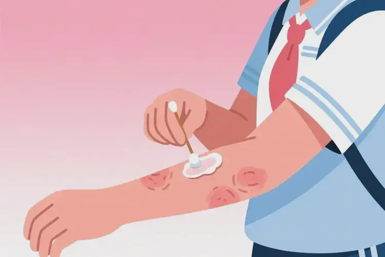 中学生手臂容易起湿疹可不可以根治(图2)