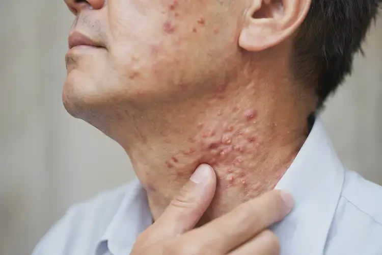 男性脖子偶爾長(zhǎng)濕疹能靠自己自愈嗎(圖4)