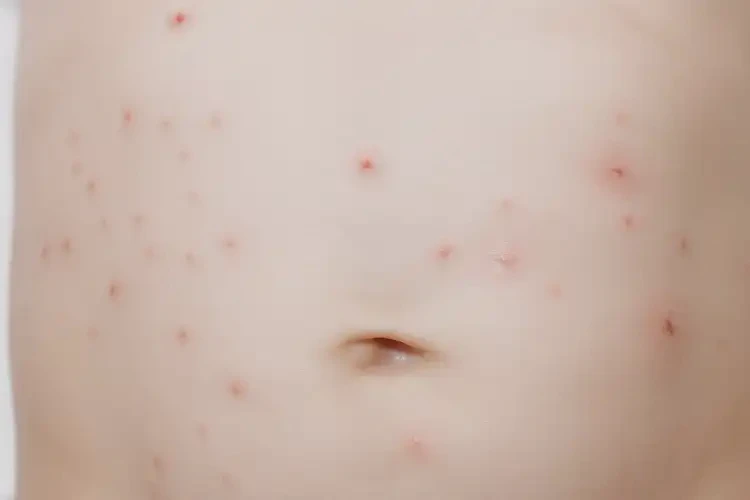 嬰幼兒肚子經(jīng)常長濕疹不管它會自己自愈嗎(圖4)