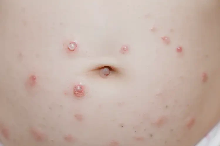 嬰兒肚子出濕疹可以治好嗎(圖4)