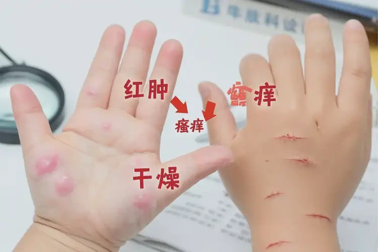 小兒手上經(jīng)常起濕疹不管它會(huì)自己自愈嗎(圖4)