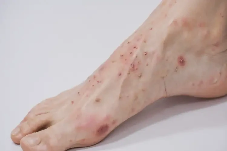 女人腳上偶爾長(zhǎng)濕疹可不可以根治(圖4)