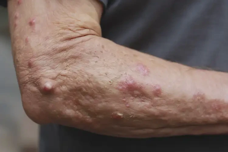 老年人手臂上長濕疹能徹底自愈嗎(圖4)