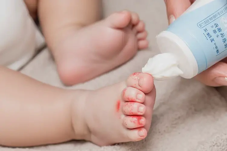 寶寶腳上出濕疹不管它會(huì)自己好嗎(圖3)