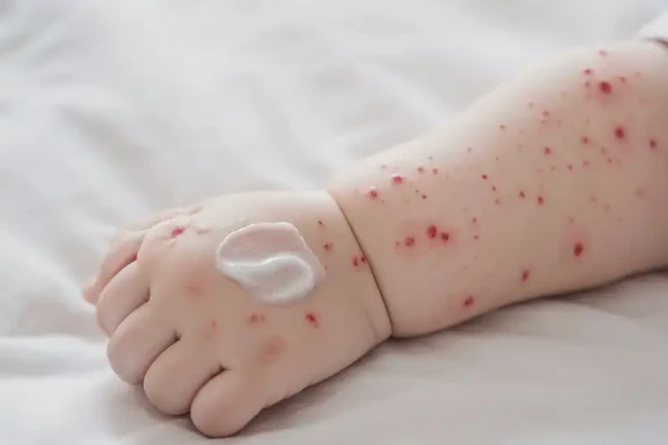 嬰兒手臂經(jīng)常長濕疹可以治好嗎(圖3)