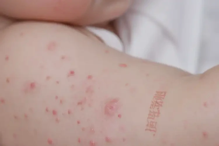 嬰兒四肢經(jīng)常起濕疹可以治好嗎(圖4)