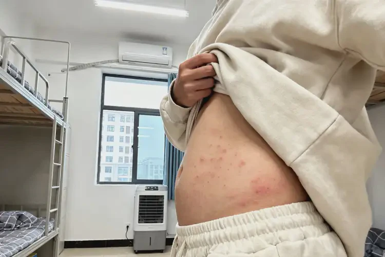 大學(xué)生肚子有濕疹能徹底自愈嗎(圖4)