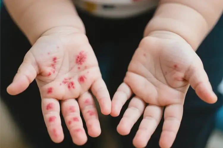 嬰幼兒手上出濕疹可以治好嗎(圖2)