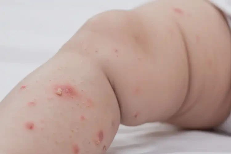 嬰幼兒小腿上出濕疹可以治好嗎(圖4)