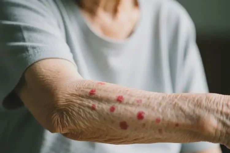 老人手臂上偶爾起濕疹可以治好嗎(圖4)