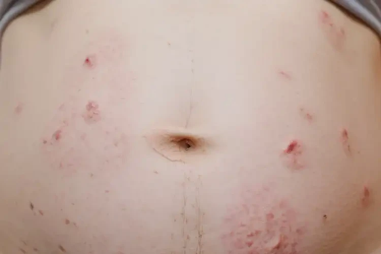 產(chǎn)婦肚子有濕疹可以治好嗎(圖4)